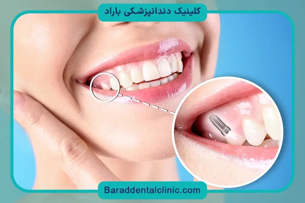 تفاوت ایمپلنت ثابت و متحرک و بررسی ایمپلنت ثابت
