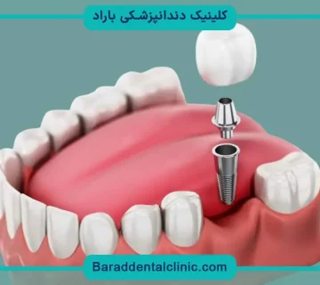 کاشت دندان غیر از ایمپلنت