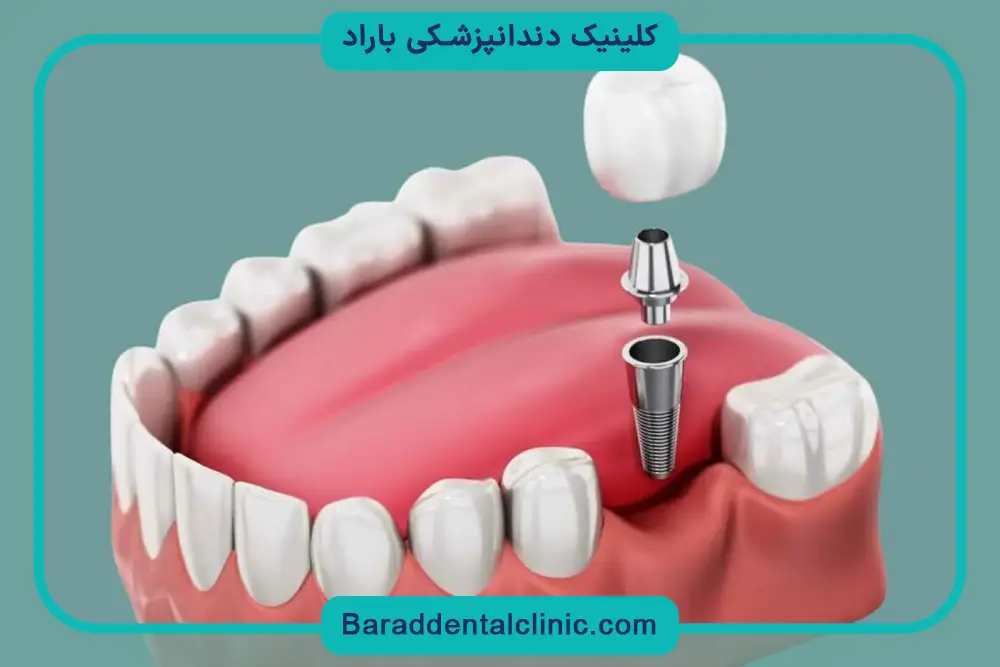 کاشت دندان غیر از ایمپلنت
