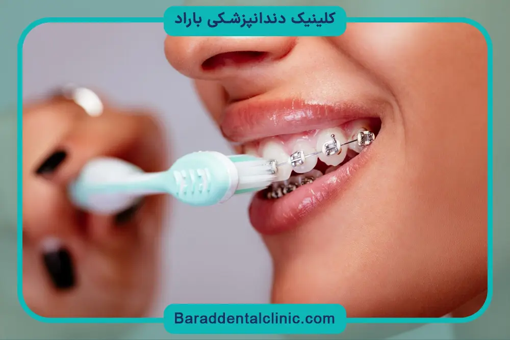 بهترین مسواک ارتودنسی 