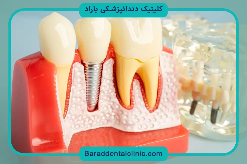 بررسی عملکرد جویدن با دندان ایمپلنت 