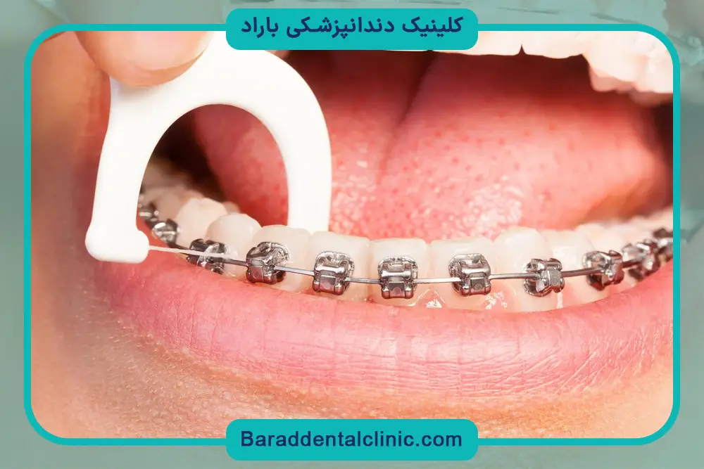 دلایل ضرورت نخ دندان ارتودنسی 