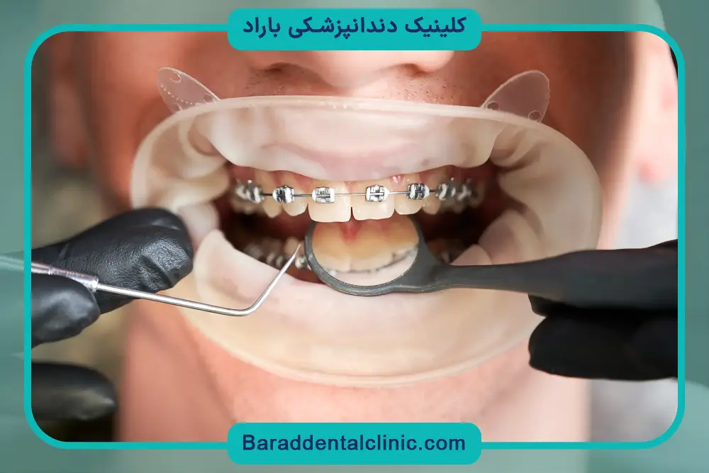 استفاده از موم ارتودنسی 