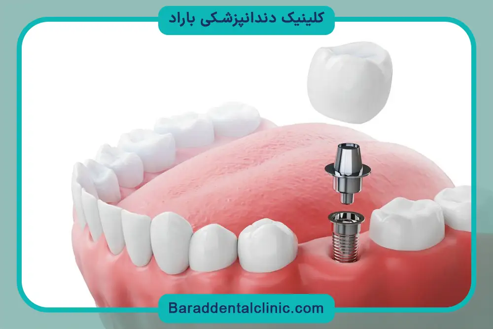 کاشت دندان چقدر طول میکشد