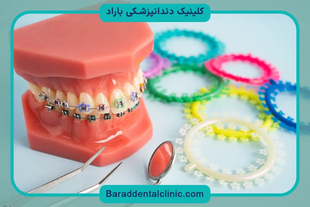 استفاده از کش ارتودنسی 