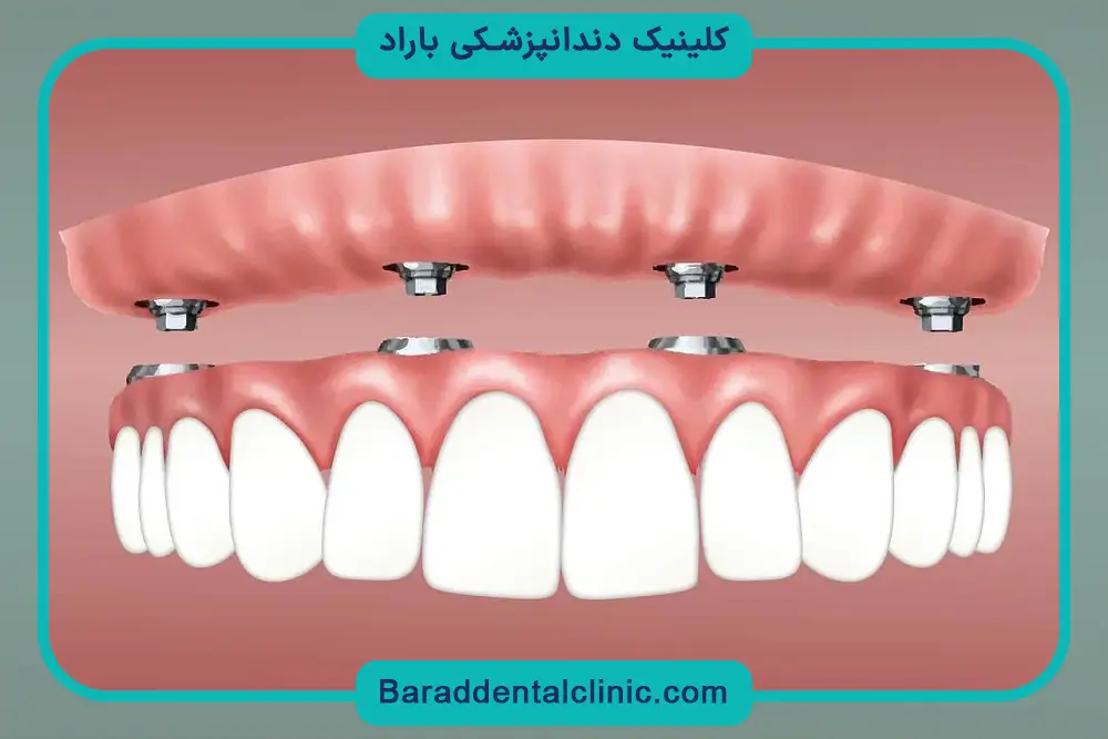 جدیدترین مدل کاشت دندان