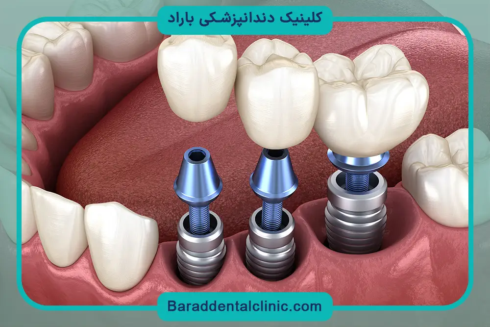بررسی کلی تفاوت ایمپلنت ثابت و متحرک 