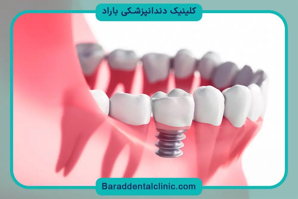 تغییرات ظاهری در عکس ایمپلنت دندان قبل و بعد 