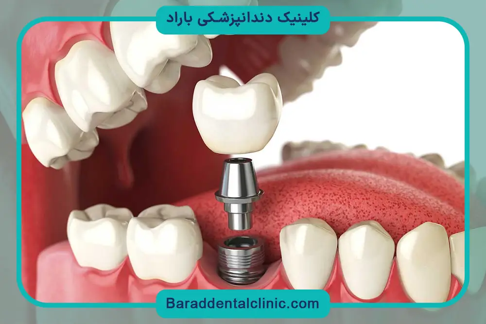 رعایت بهداشت دندان و جلوگیری از عفونت ایمپلنت