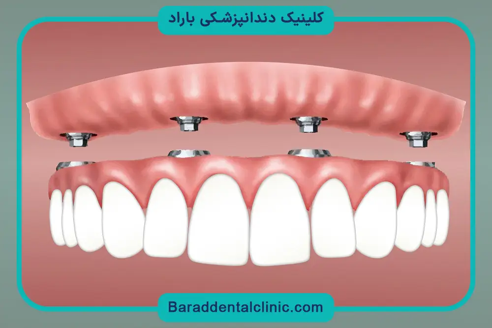 مزایای ایمپلنت بلافاصله بعد از کشیدن دندان 