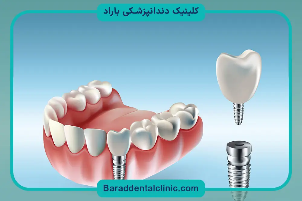 نقش تراکم استخوان در سخت ترین مرحله ایمپلنت