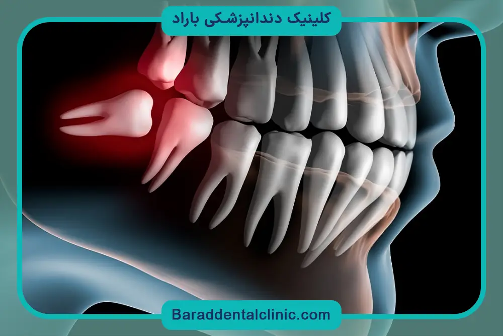 مقایسه هزینه ایمپلنت با دندان مصنوعی