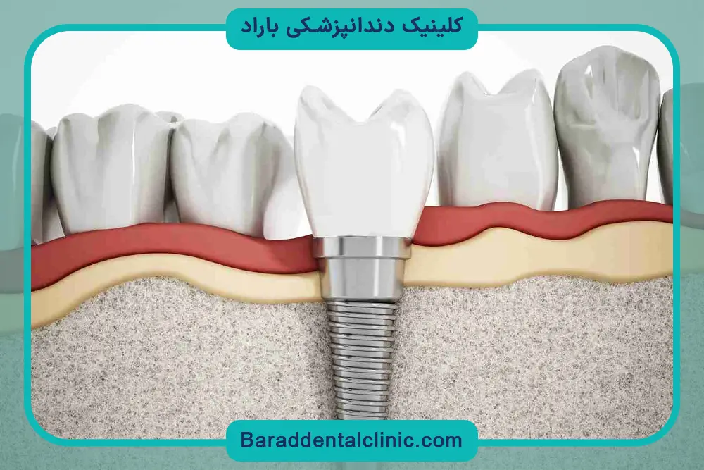 ایمپلنت پیچی بهتر است یا چسبی؟ مقایسه میزان استحکام