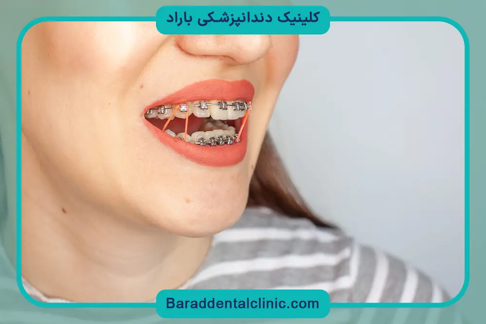 اشتباهات رایج در استفاده از کش ارتودنسی 
