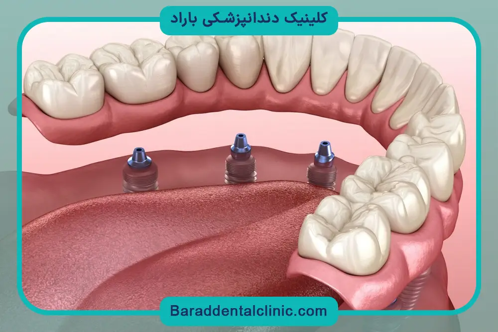 ایمپلنت ثابت بهتر است یا متحرک؟ بررسی دوام