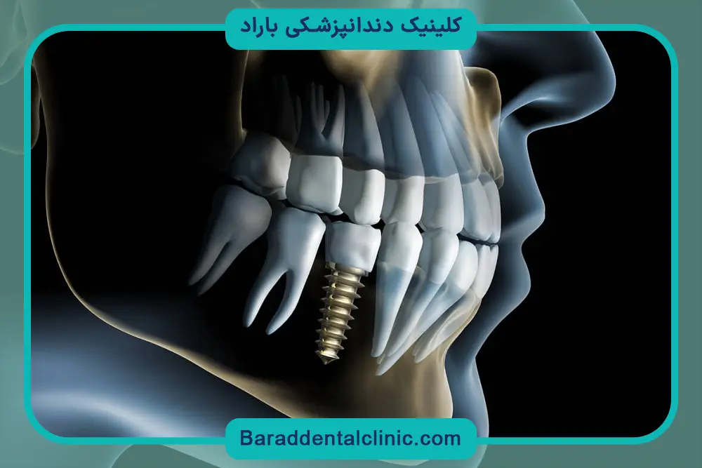 جدیدترین روش کاشت دندان