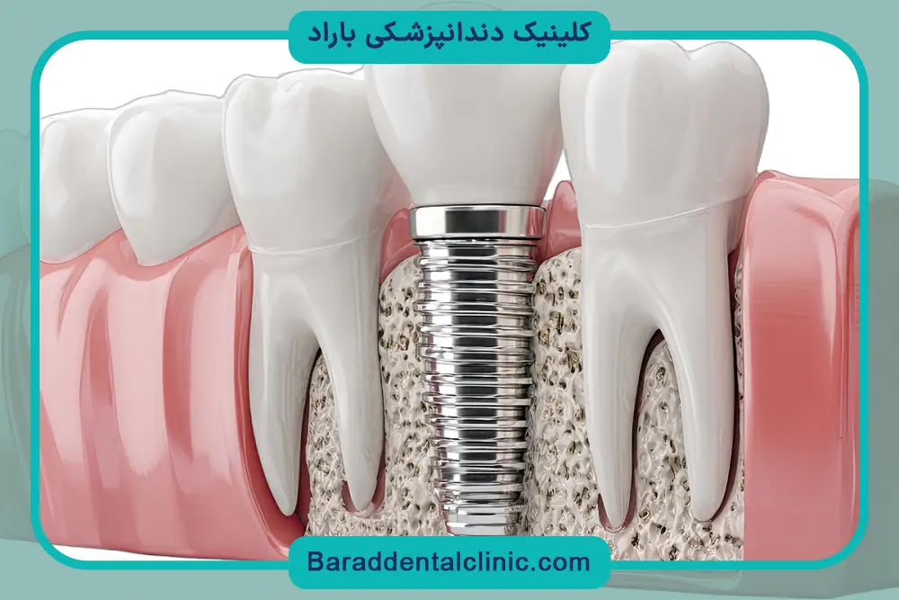 چالش‌های سخت ترین مرحله ایمپلنت