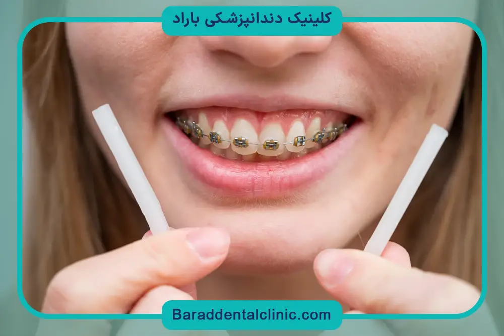 مزایا و معایب موم ارتودنسی 
