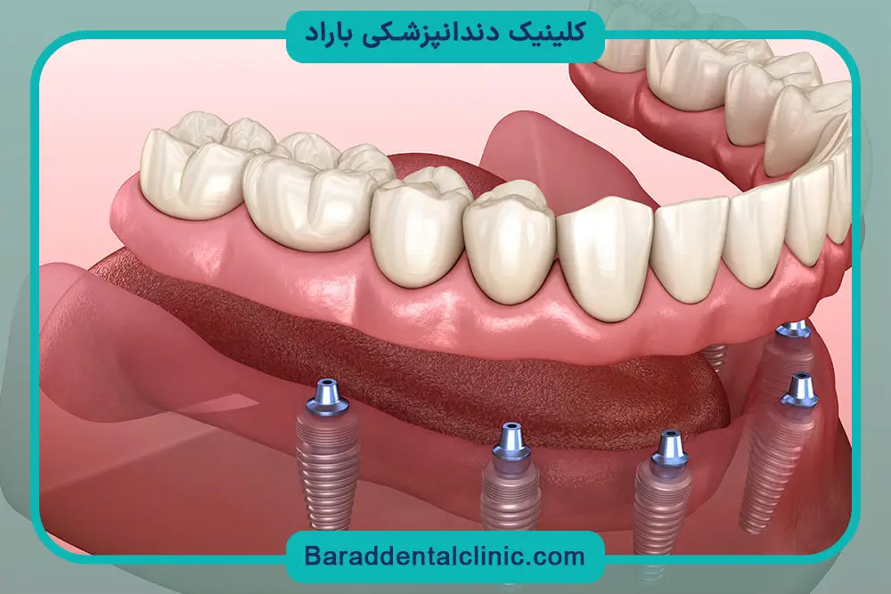 جراحی ایمپلنت فک پایین