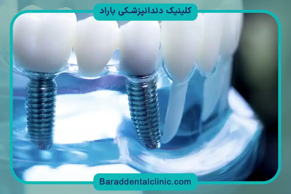 فیکسچر دندان چیست