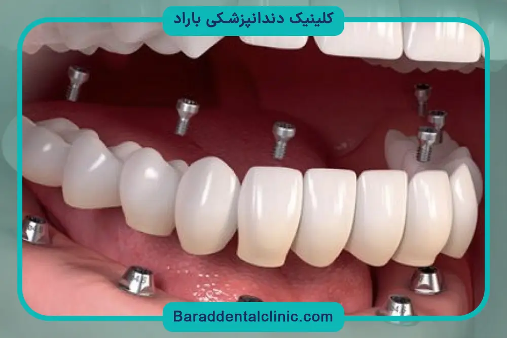 قیمت کاشت دندان
