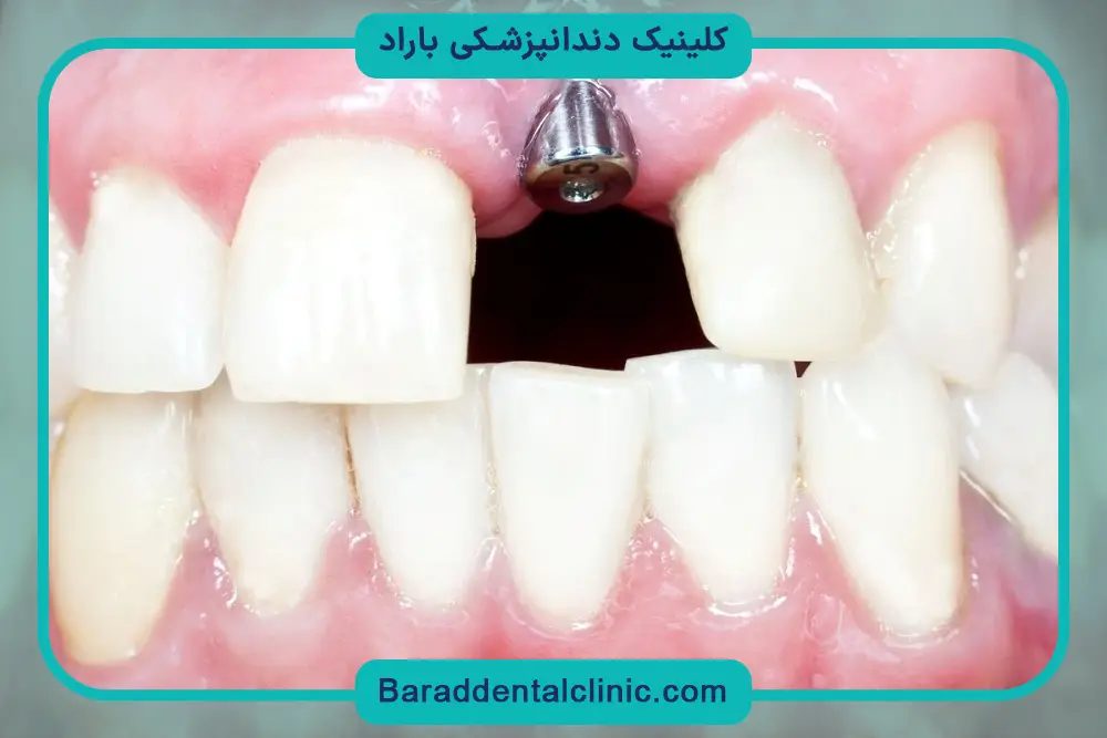 هزینه کاشت دندان جلو بالا