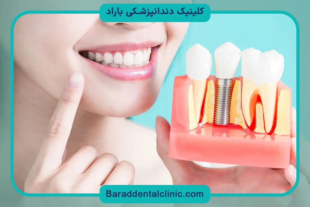 کاشت دندان چقدر هزینه دارد