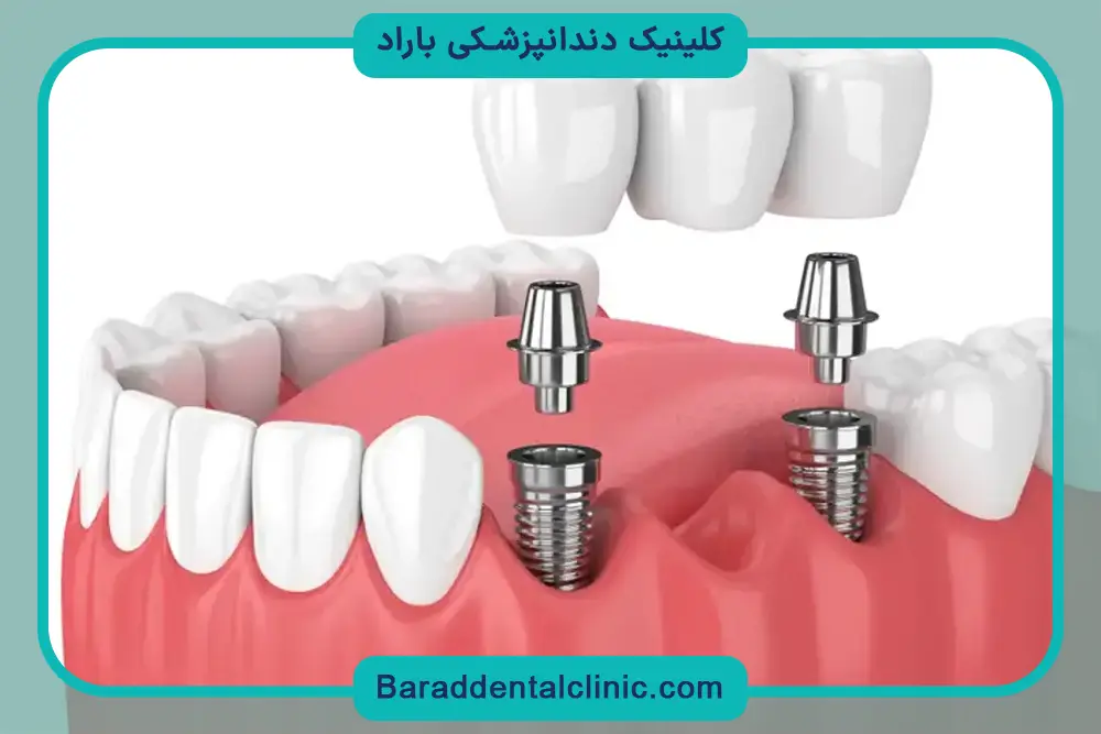 فیکسچر ایمپلنت دندان چیست؟