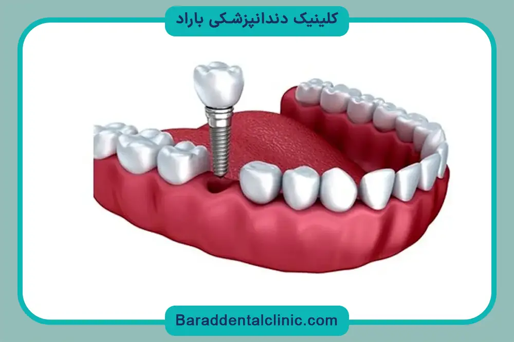 کاشت دندان ارزان چیست؟