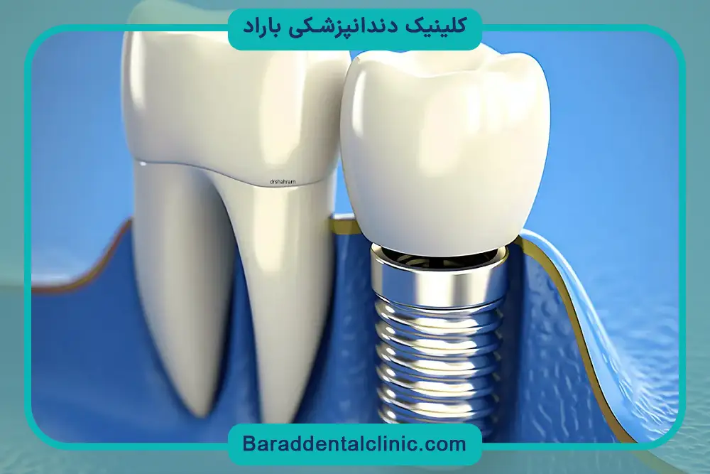 کاشت دندان اقساطی چیست؟