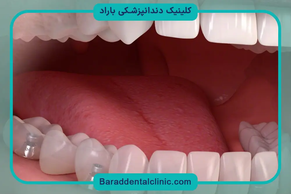 جراحی ایمپلنت فک پایین  چیست؟