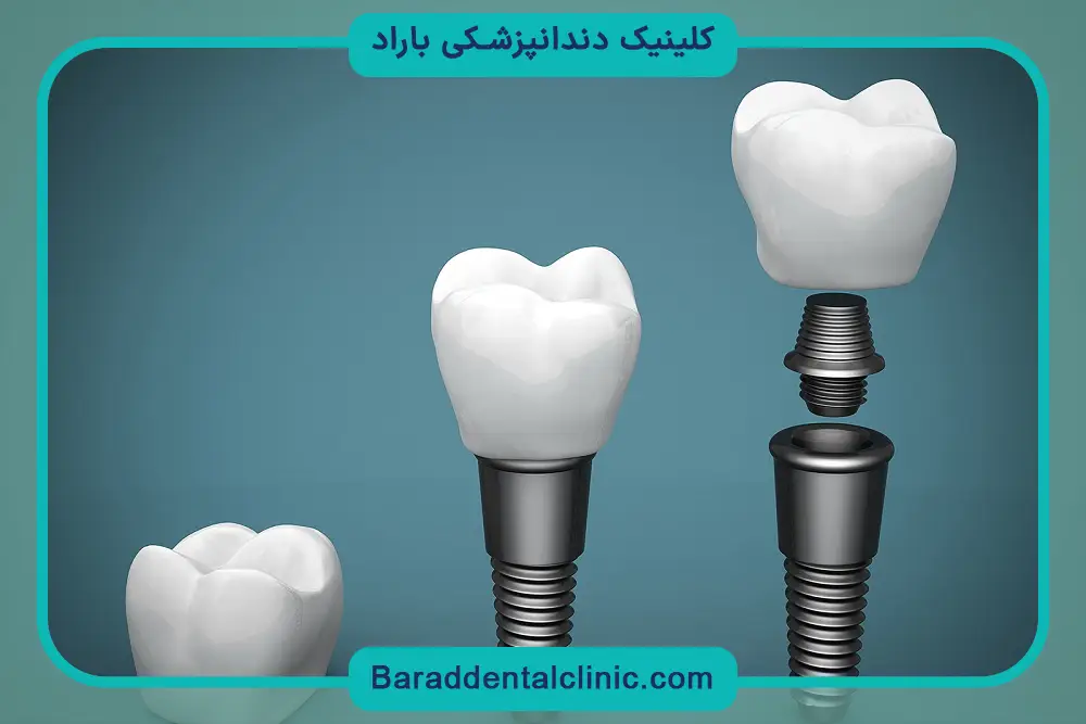 فیکسچر ایمپلنت چیست؟