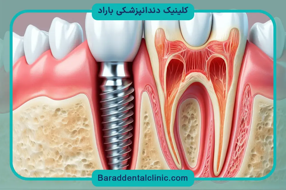 فیکسچر دندان چیست؟ بررسی کلی