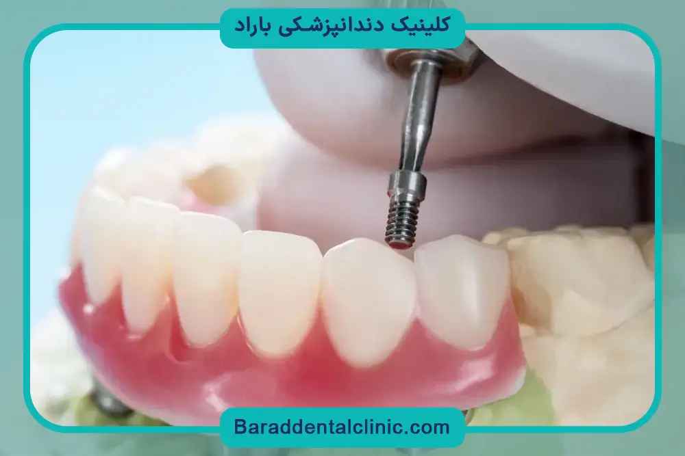 معایب و محدودیتهای کاشت دندان چسبی