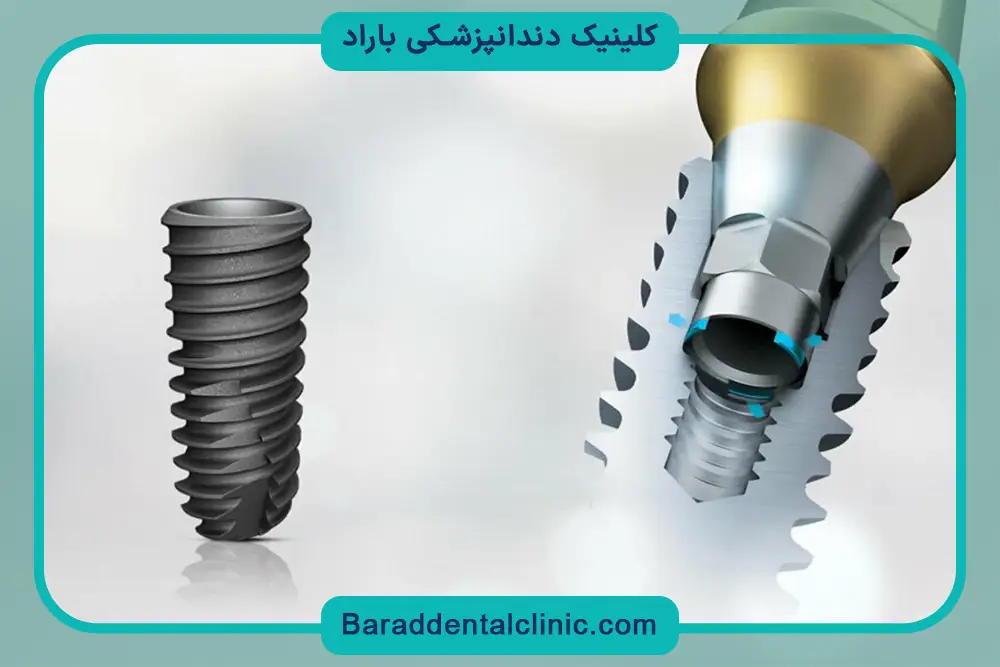 محدودیت‌های فیکسچر ایمپلنت کره ای 