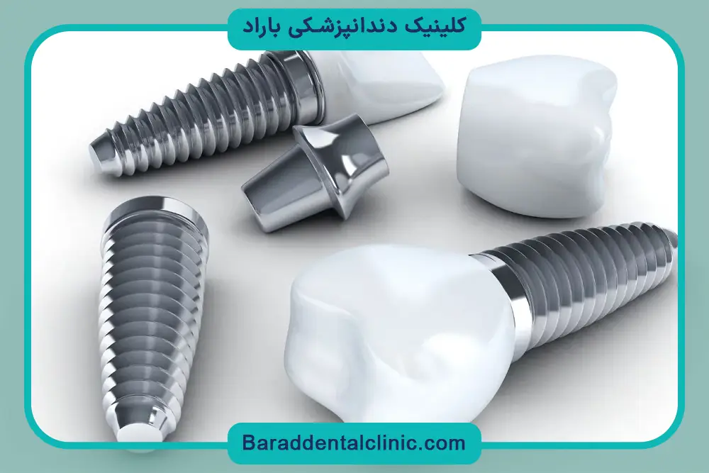 فیکسچر ایمپلنت چیست؟ نحوه قرارگیری