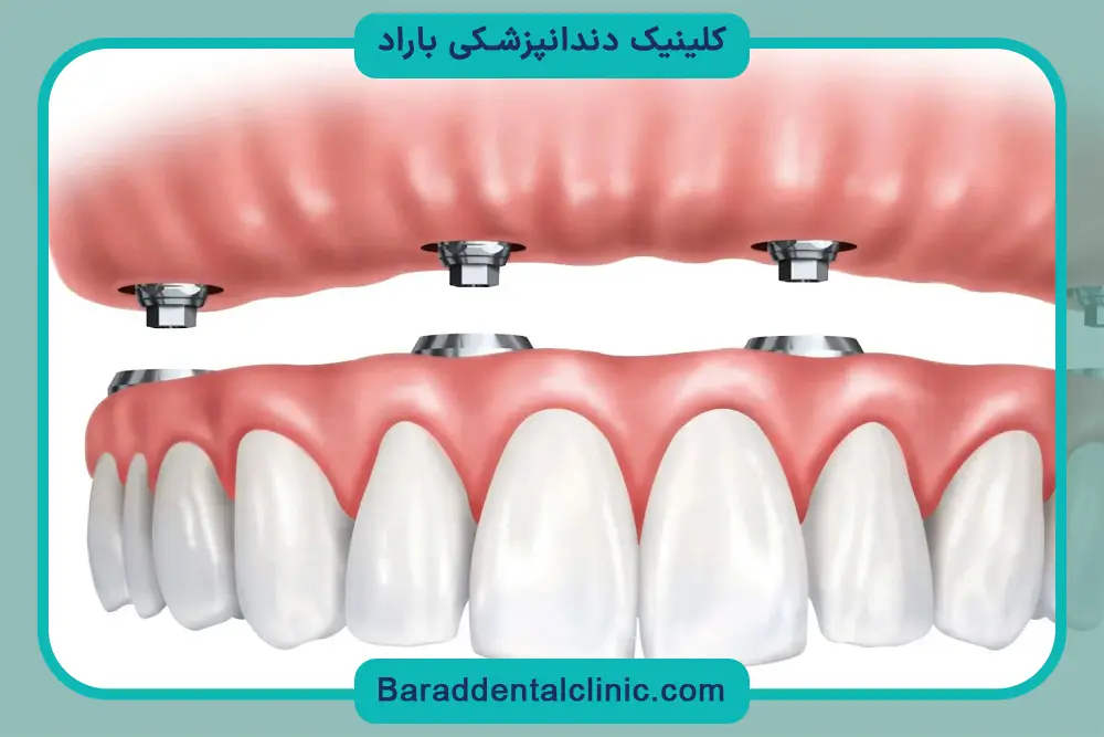 کاشت دندان ایمپلنت قیمت بالایی دارد؟