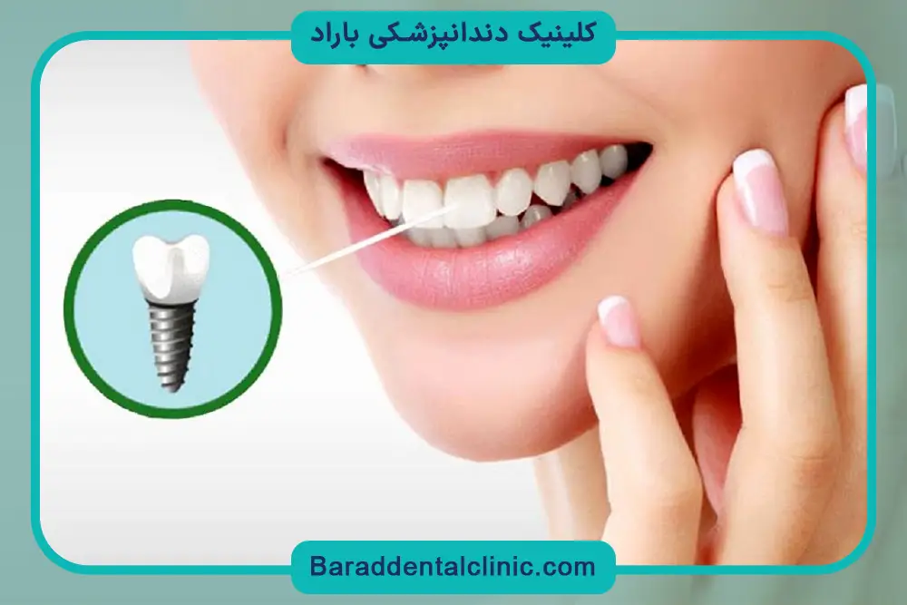 عوامل موثر بر هزینه کاشت دندان جلو بالا 
