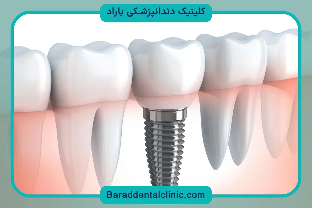 شرایط کاشت دندان اقساطی 