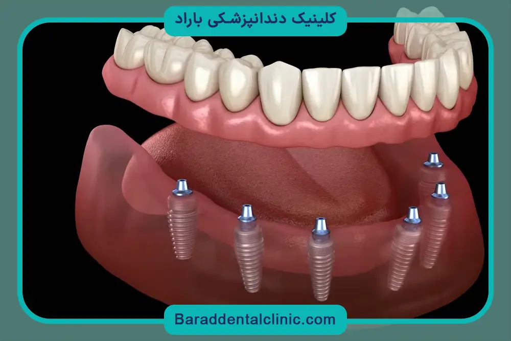 مراحل جراحی ایمپلنت فک پایین 