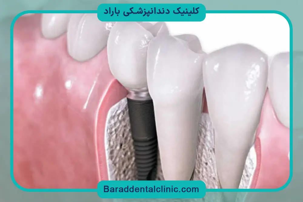 عوامل موثر بر هزینه ایمپلنت دندان 