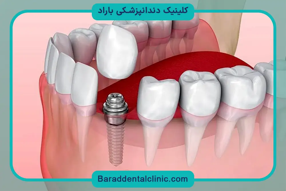 ارزش قیمتی فیکسچر ایمپلنت کره ای 