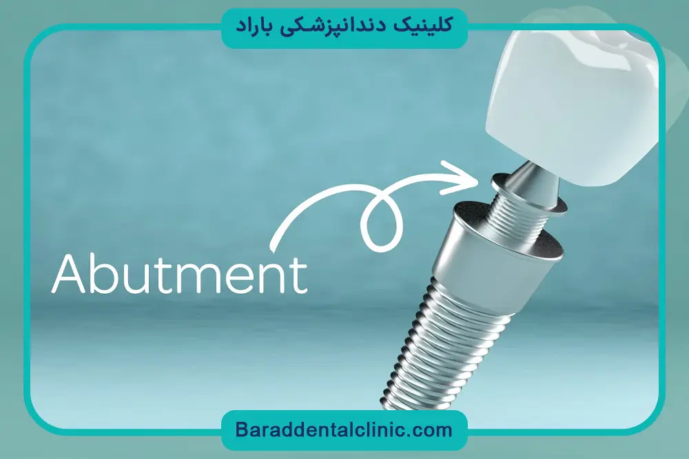 مراحل نصب فیکسچر ایمپلنت دندان 
