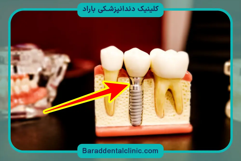 فیکسچر ایمپلنت چیست؟ نکات مهم