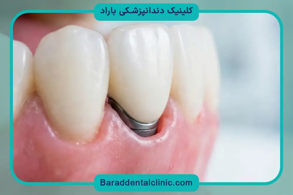 کاشت دندان ایمپلنت قیمت و هزینه‌های جانبی