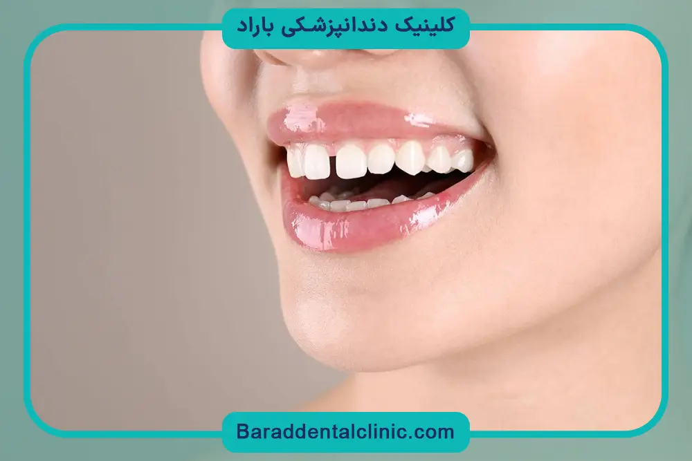 موارد جانبی در هزینه کاشت دندان جلو بالا 