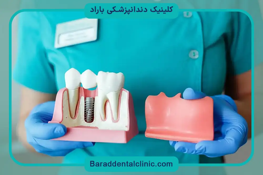 تاثیر برند ایمپلنت روی کاشت دندان ارزان 