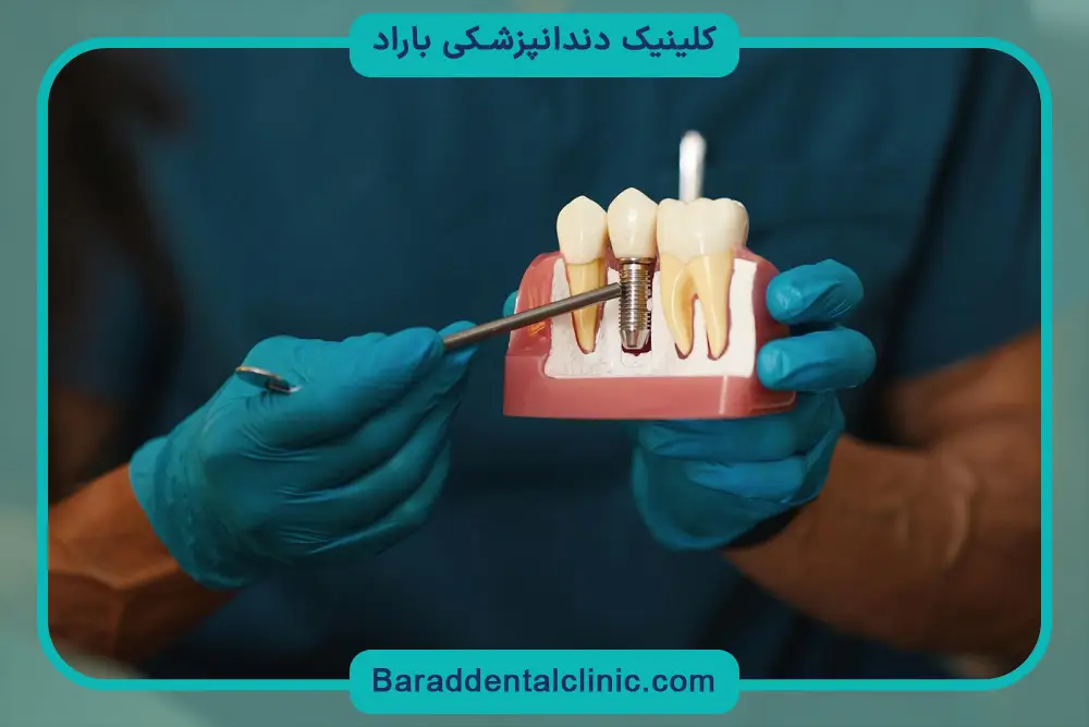 انتخاب بهترین کلینیک کاشت دندان اقساطی 
