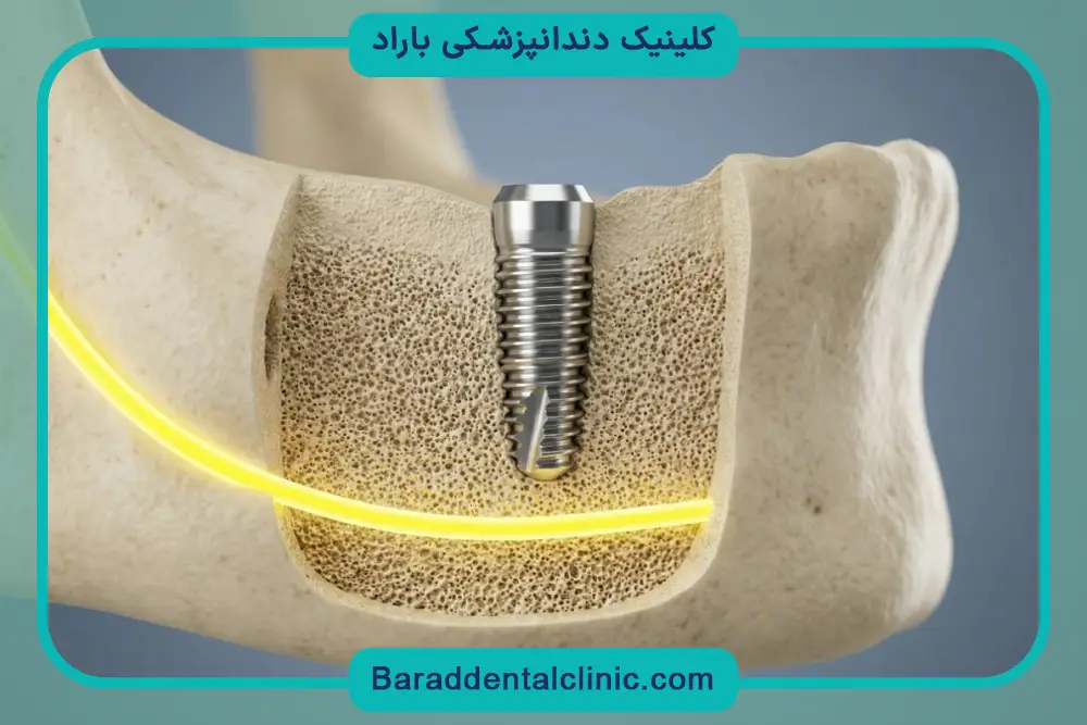 مدیریت درد بعد از جراحی ایمپلنت فک پایین 