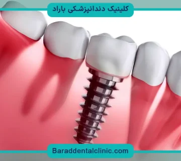 ایمپلنت دندان چگونه است